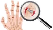 Arthritis Pannel  32 (Parameter )
